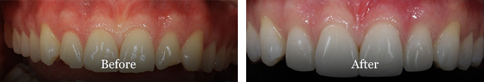 before and after treatment