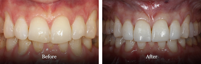 before and after treatment