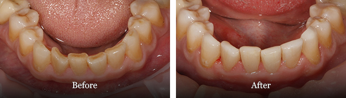 before and after treatment