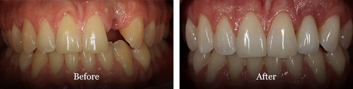 before and after treatment