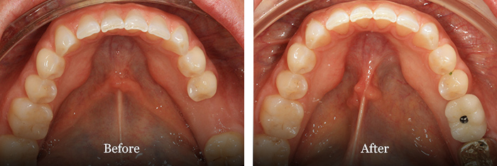 before and after treatment