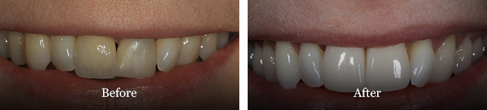 before and after treatment