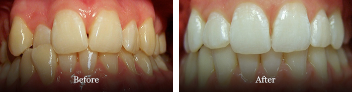 before and after treatment