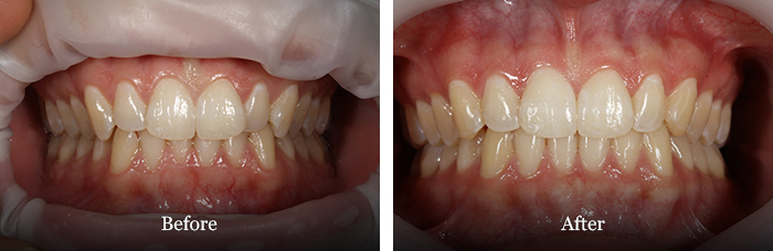 before and after treatment