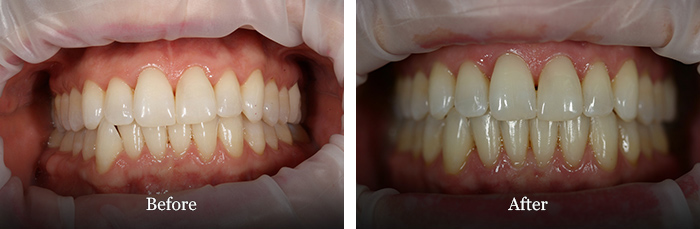 before and after treatment