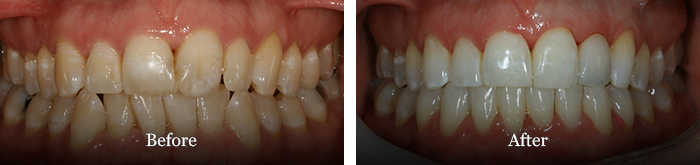 before and after treatment