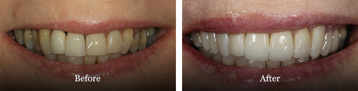 before and after treatment