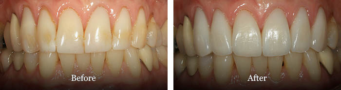 before and after treatment