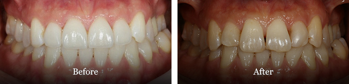 before and after treatment