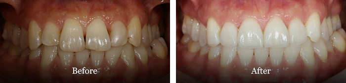 before and after treatment